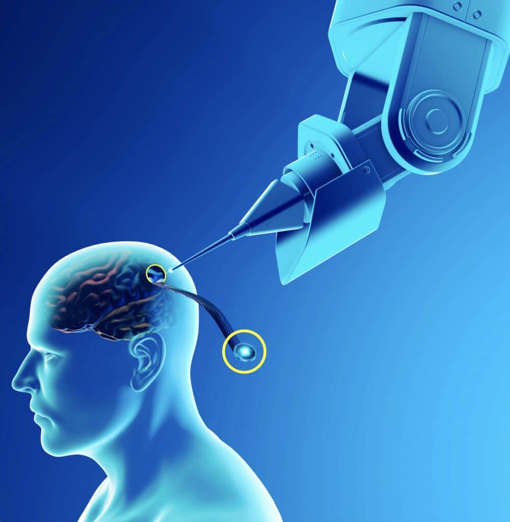 Neuralink brain chip 